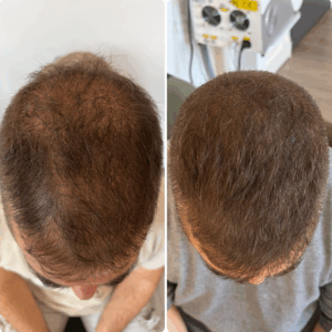 tricopigmentation paris homme densification