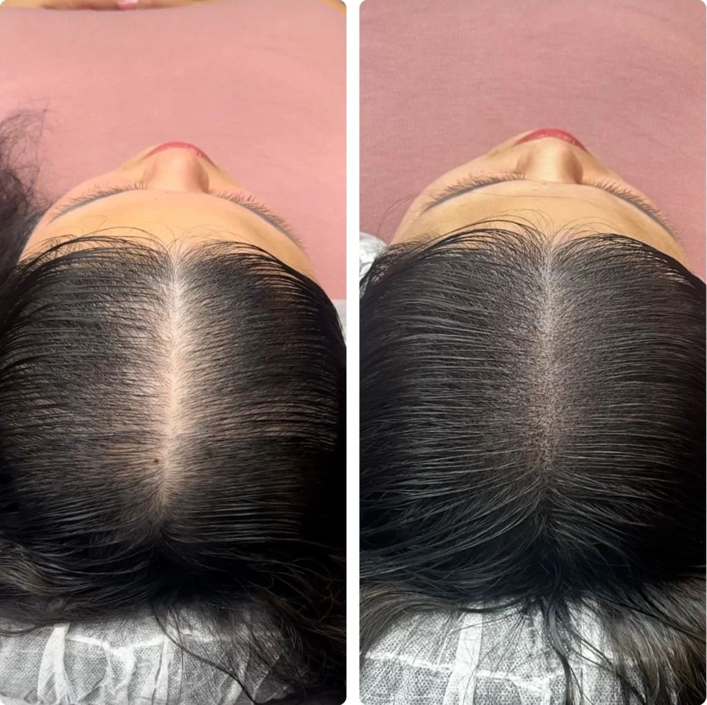 Avant après densification capillaire femme par tricopigmentation