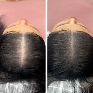 Avant après densification capillaire femme par tricopigmentation