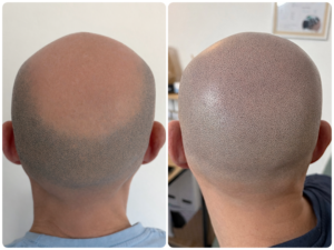 Restauration d'un vertex faite par tricopigmentation en ile de france