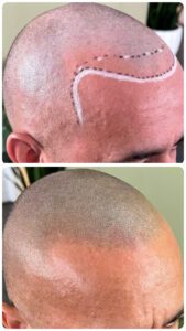 Crane rasé avec tracage de ligne frontale premiere seance tricopigmentation perfection pigment