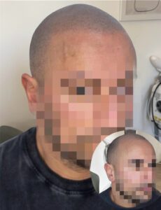 Effet rasé complet d'un homme grace a la tricopigmentation en essonne chez perfection pigment