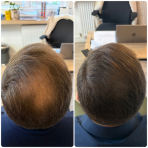 Densification homme haut du crane plus vertex en trichopigmentation ile de france