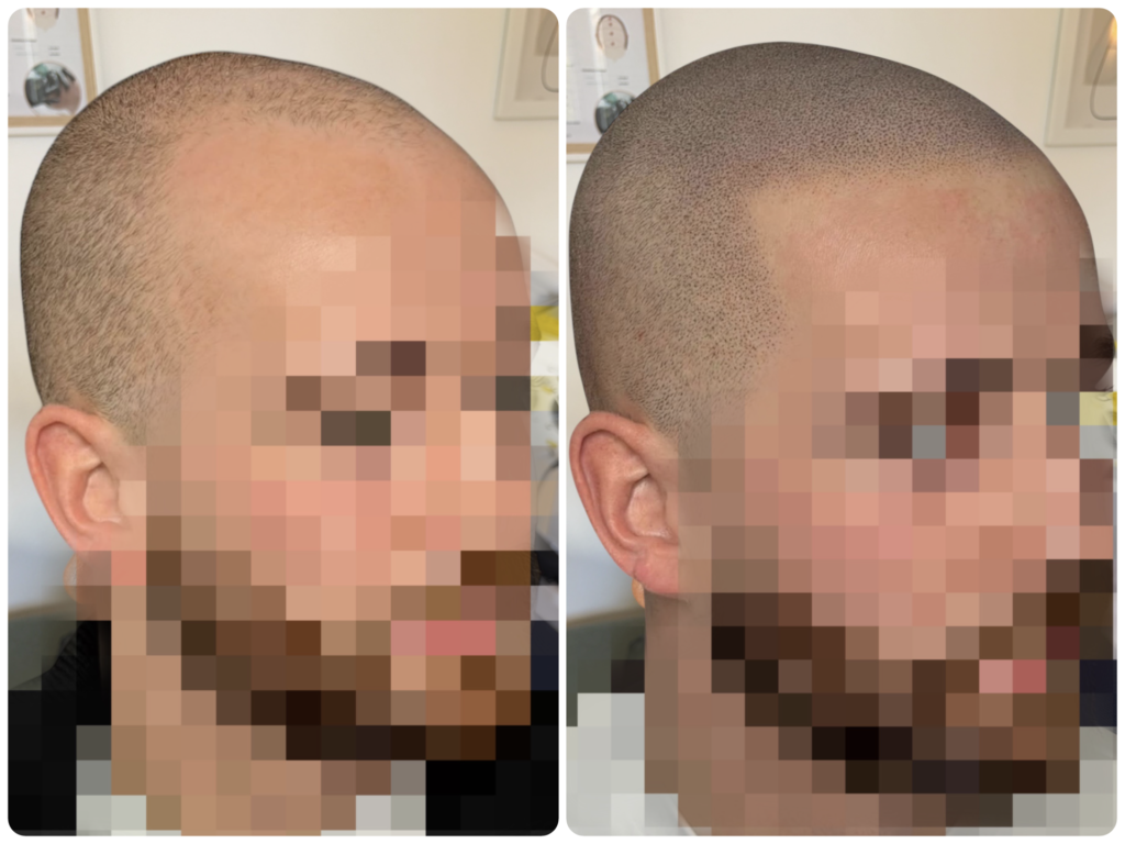 crane rasé avant apres effet naturel en micropigmentation capillaire en essonnes
