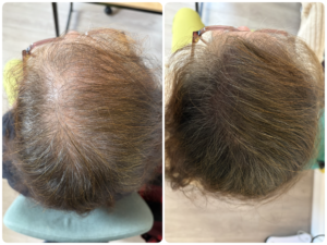 Densification femme en micropigmentation capillaire rendu naturel
