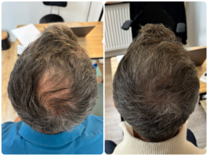 Densification vertex clairsemé dermopigmentation capillaire evry