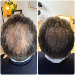 densification d'un vertex suite a une greffe de cheveux en turquie qui manquais de densité evry