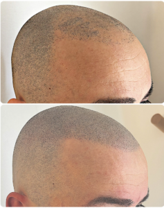correction d'une greffe raté a paris en micropigmentation