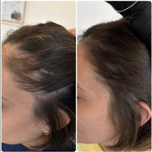 restauration d'une Alopecie femme grace a la tricopigmentation suite a une alopecie de traction