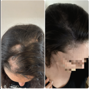 Correction d'une pelade sur jeune femme en tricopigmentation capillaire en essonnes