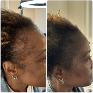 Densification tricopigmentation femme peau mat qui a perdu ses cheveux a cause de la traction en ile de france