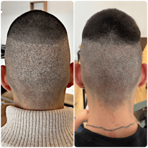 Correction de cicatrice FUE suite a une greffe de cheveux sainte genevieve des bois