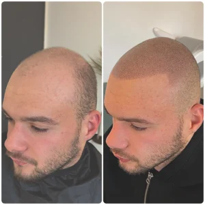 restauration d'un calvitie par tricopigmentation esonne
