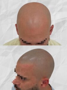 Effet crane rasé ligne naturel en micropigmentation capillaire en essonne