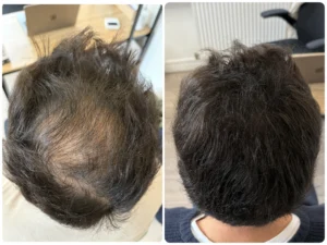 Densification homme tricopigmentation