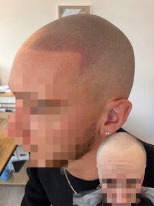 avant apres crane rasé jeune homme effet barber en tricopigmentation capillaire en ile de france