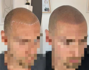 refonte de ligne frontale grace a la micropigmentation a morsang sur orges