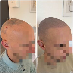 Pelade effet crane rasé homme tricopigmentation