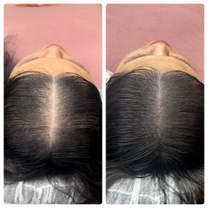 Densification d'une raie pour une femme par dermopigmentation