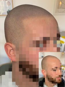 avant apres d'un crane rasé restaurer grace a la tricopigmentation Paris