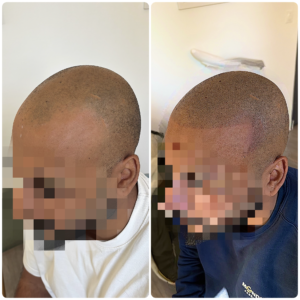 Avant apres crane rasé effet naturel en tatouage capillaire evry