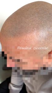 Résultat d'une tricopigmentation a paris cicatrisé