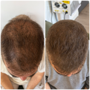 Densification capillaire cicatrisé Homme apres greffe de cheveux micropigmentation essonne