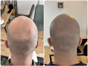 vertex avant apres une tricopigmentation perfection pigment